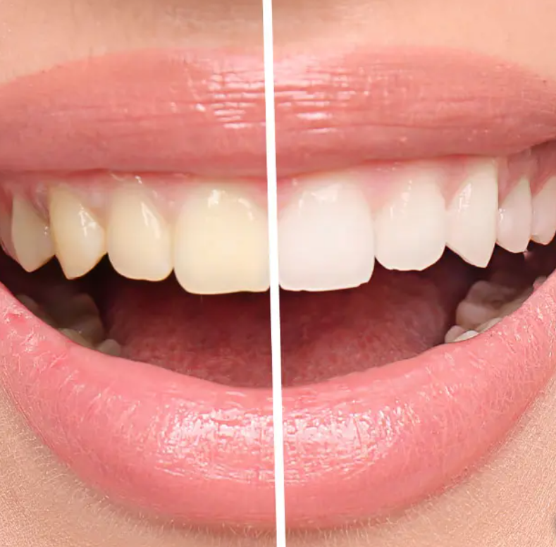 Do Teeth Whitening Pens work? Face Teeth Smile Shop Ltd