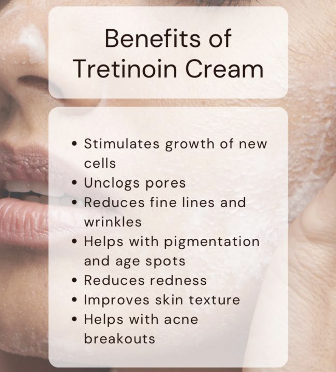 Tretinoin Cream 0.1%, 0.025% and 0.05% Cream 20gms